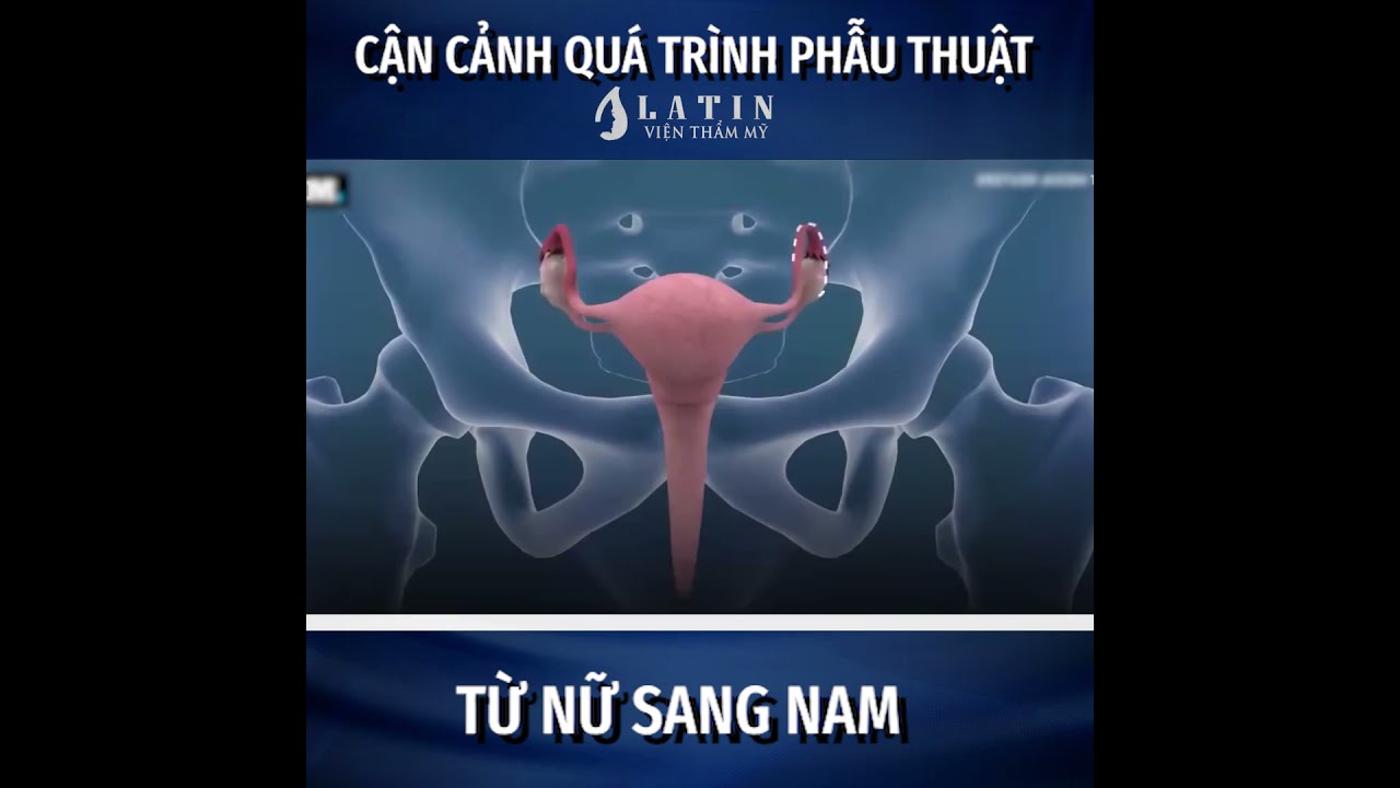 Chi phí phẫu thuật chuyển giới