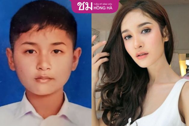 Phẫu thuật chuyển giới nam thành nữ