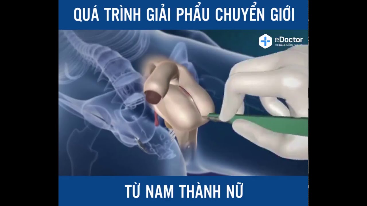Quy trình phẫu thuật chuyển giới