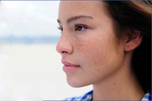 Hormone Điều Trị Nám Da
