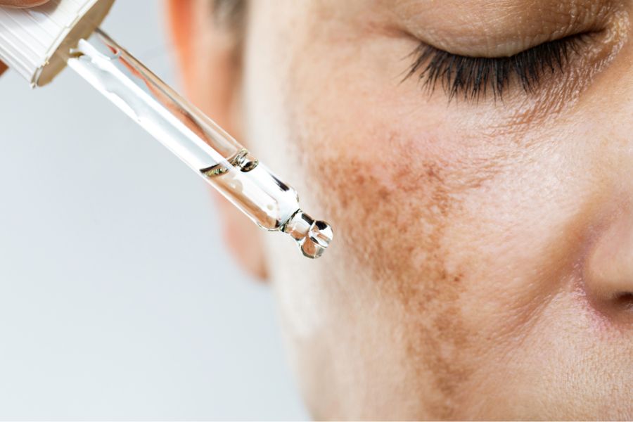 Hormone Điều Trị Nám Da