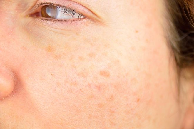 Hormone Điều Trị Nám Da